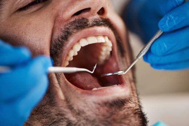 Best Emergency Wisdom Tooth Extraction in Bangor, WI